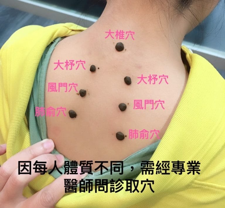 呼吸自在，舒緩過敏─三伏貼的神奇效用